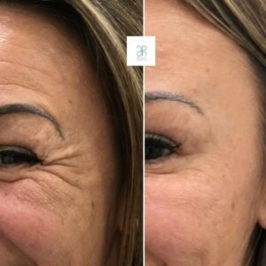 Tratamiento contorno del ojo con botox
