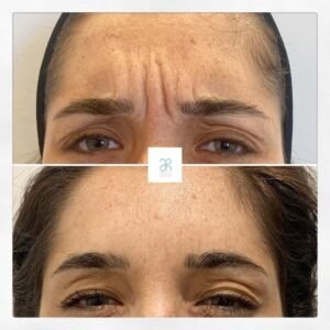 Tratamiento en la frente con botox