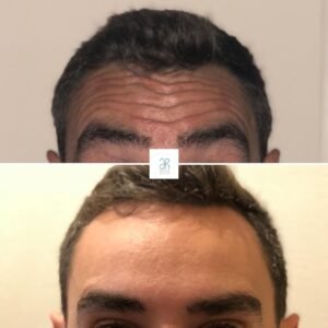 Bótox frente antes y después realizado por el Dr. Holguera. Experto en aplicación de bótox frente.
