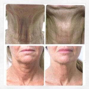 Tratamiento acido hialuronico en el cuello