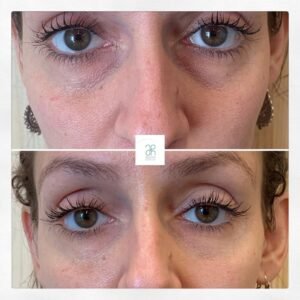 Tratamiento con acido hialuronico en los ojos y contorno