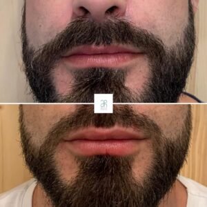 Tratamiento con acido hialuronico boca y labios