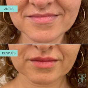 Tratamiento con acido hialuronico boca y labios