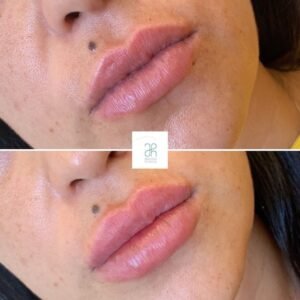 Tratamiento con acido hialuronico boca y labios
