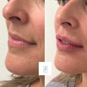 Tratamiento con acido hialuronico boca y labios