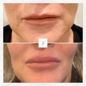 Tratamiento con acido hialuronico boca y labios