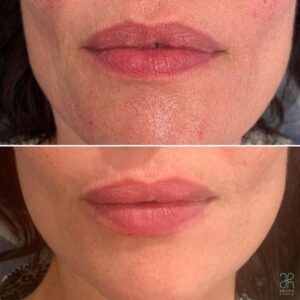 Tratamiento con acido hialuronico boca y labios