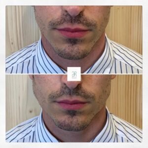 Tratamiento con acido hialuronico boca y labios