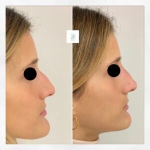 Tratamiento con acido hialuronico nariz mandibula y pomulos