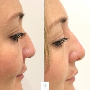 Tratamiento con acido hialuronico nariz mandibula y pomulos