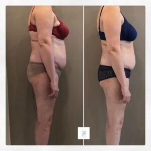 tratamiento mesoterapia reductora de grasa